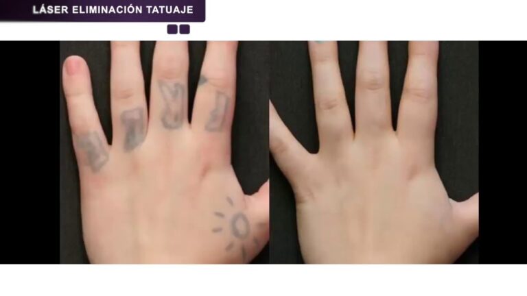 Cursos de L&aacute;ser para Remoci&oacute;n de Tatuajes en Chile