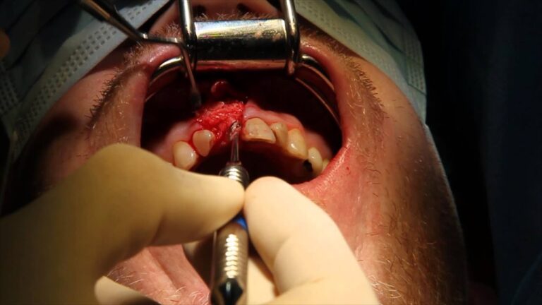 Curso de Regeneraci&oacute;n &Oacute;sea Dental en Chile